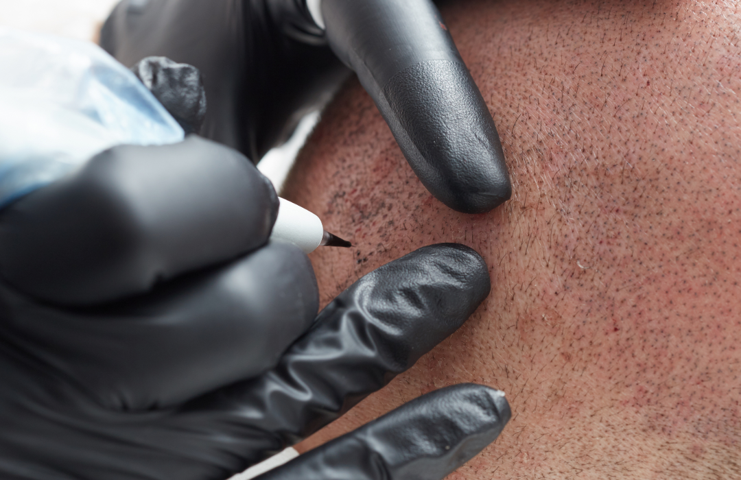 Tricopigmentation du cuir chevelu